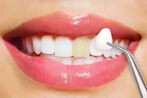 Can-Veneers-Fix-Gaps-in-Teeth