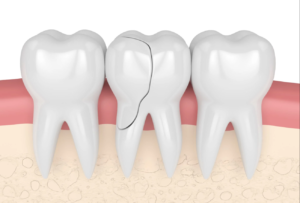 A teeth having a crack