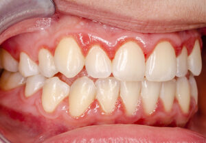 What-are-the-signs-of-gum-disease